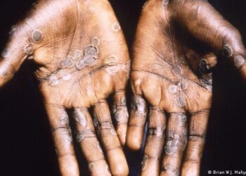 La viruela del mono encendió las alarmas de la OMS