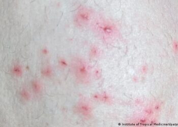 OMS reporta 780 casos de viruela del mono, la mayoría en Europa