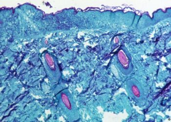 ¿Es la viruela del mono una enfermedad de transmisión sexual?