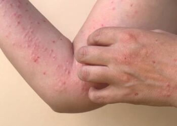 Confirman en Barranquilla el primer caso de la viruela del mono