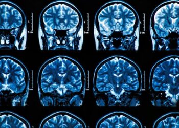 Un fármaco experimental contra el alzheimer logra frenar el deterioro