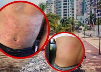 Extraño brote cutáneo alerta a población de Santa Marta: sospechan virus, no contaminación marina